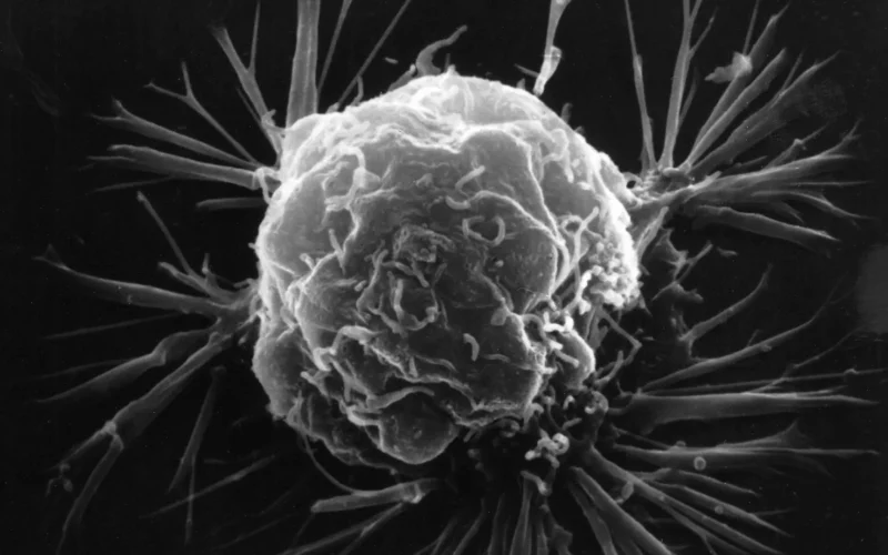 Representative image of cancer.