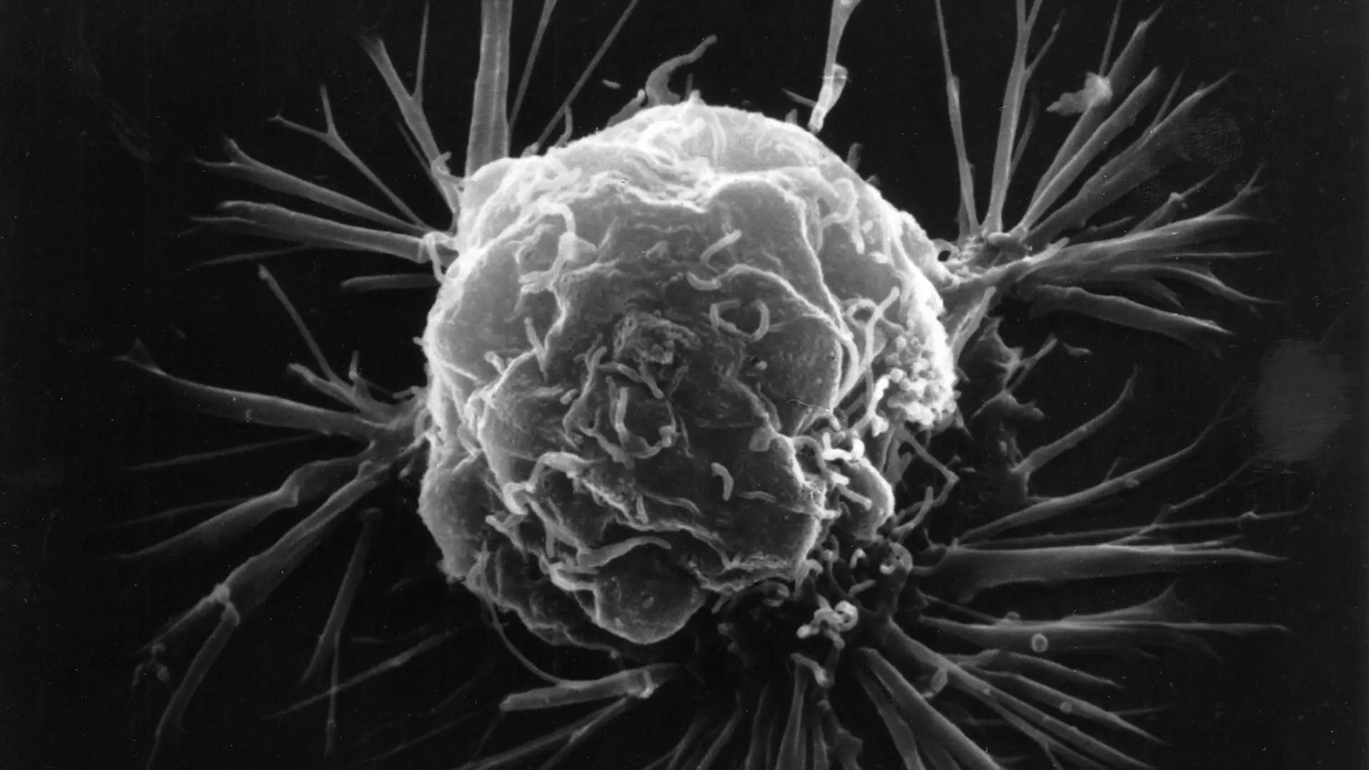 Representative image of cancer.
